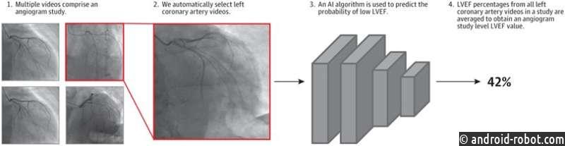 ИИ используют для прогнозирования важного показателя работы сердца